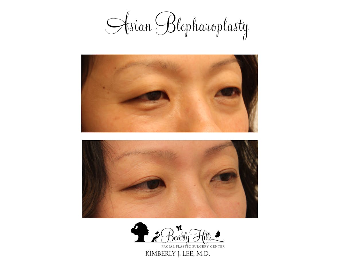 Eyelids Before & After Gallery - Patient 85944562 - Image 2