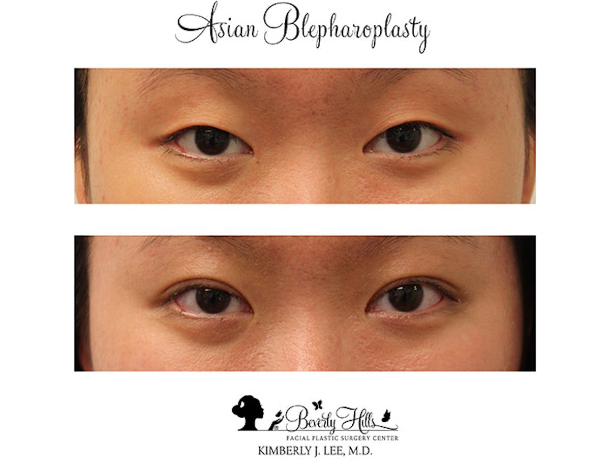 Eyelids Before & After Gallery - Patient 85944565 - Image 1