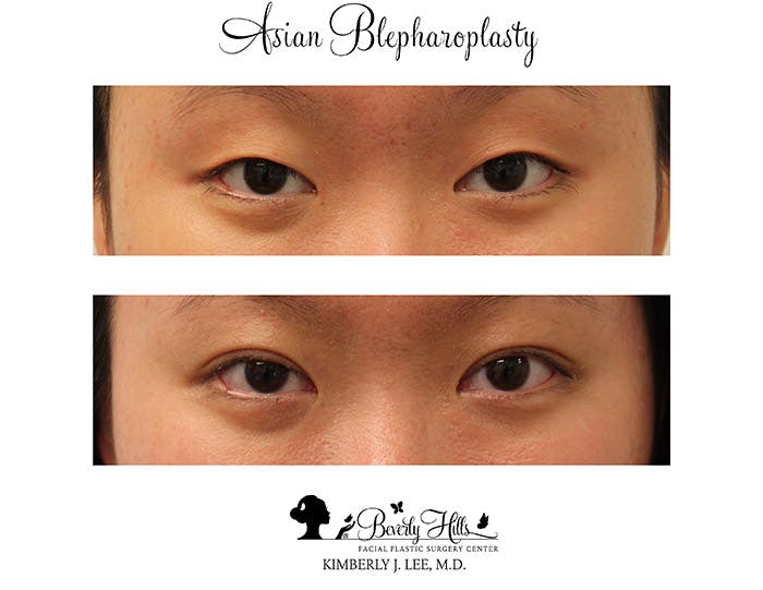 Eyelids Before & After Gallery - Patient 85944565 - Image 1