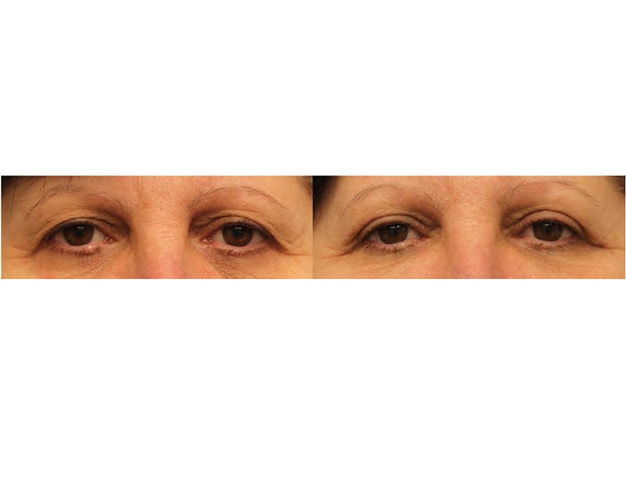 Eyelid Lift