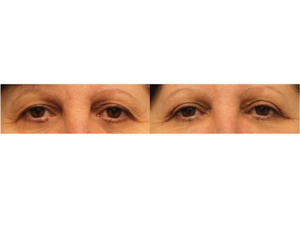 Eyelids Before & After Gallery - Patient 85944580 - Image 1