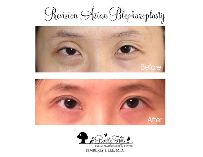 Asian Eyelid Surgery