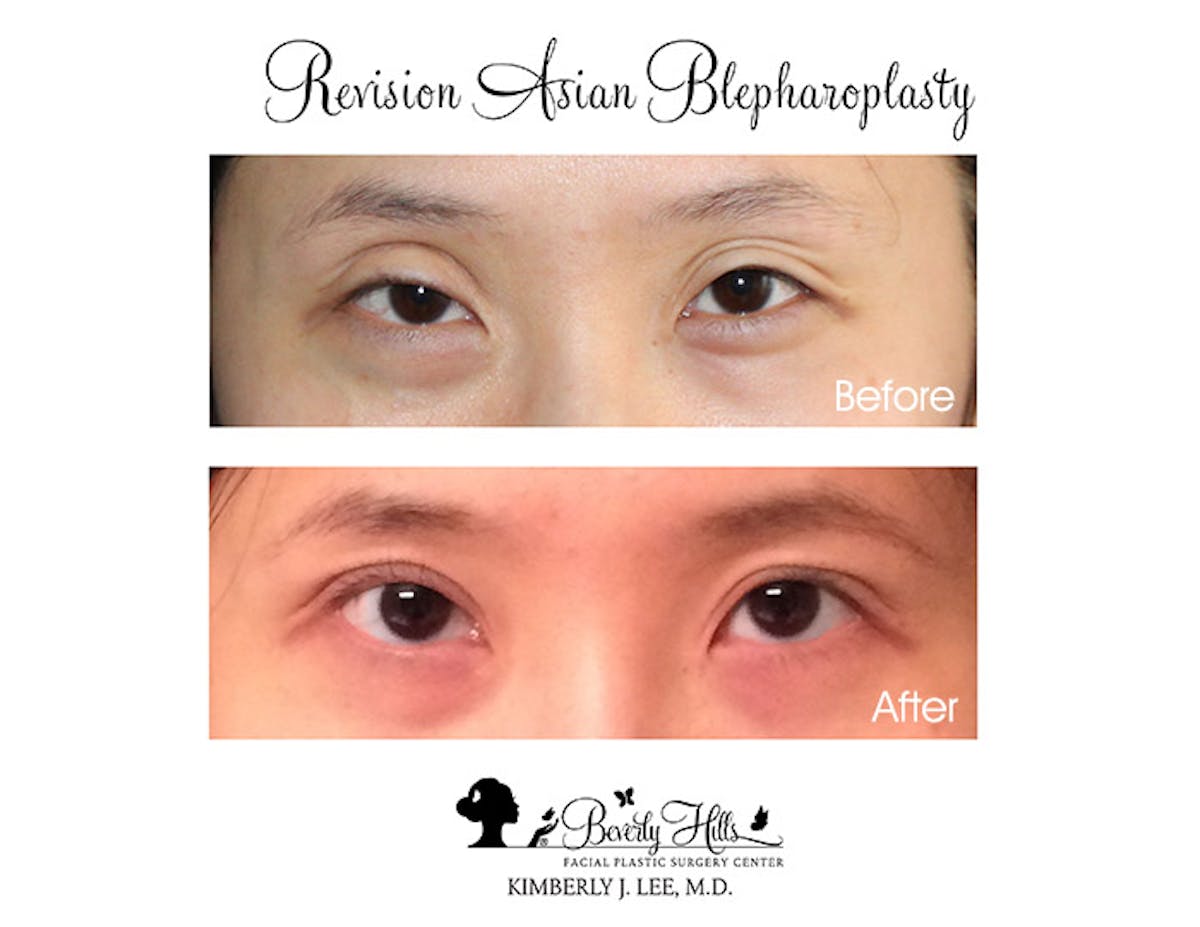 Eyelids Before & After Gallery - Patient 85944581 - Image 1