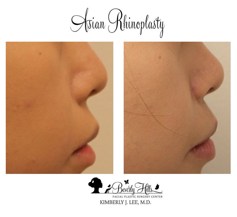 Rhinoplasty Before & After Gallery - Patient 85944606 - Image 5