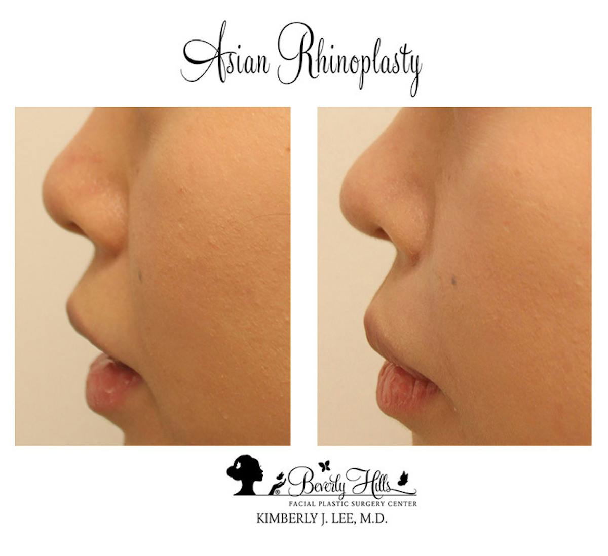 Rhinoplasty Before & After Gallery - Patient 85944606 - Image 4