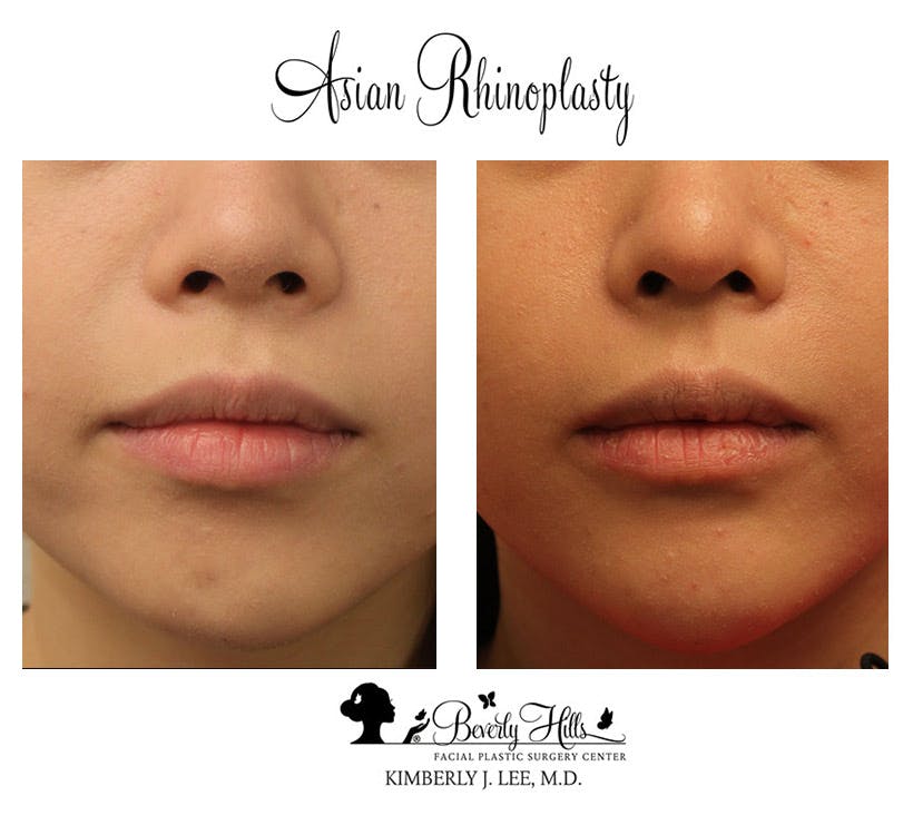 Rhinoplasty Before & After Gallery - Patient 85944606 - Image 3