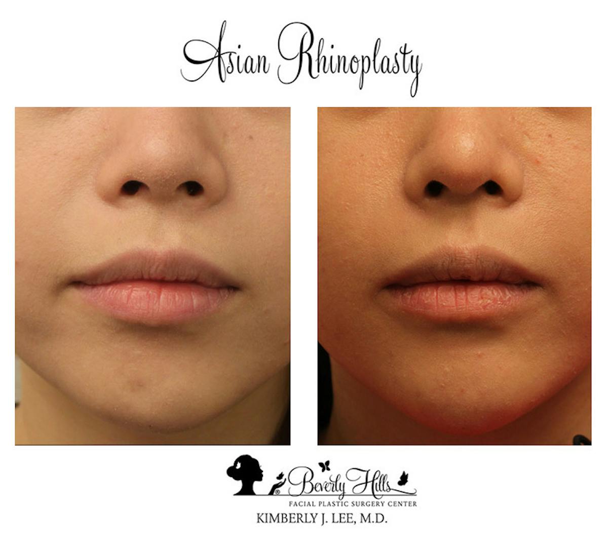 Rhinoplasty Before & After Gallery - Patient 85944606 - Image 3