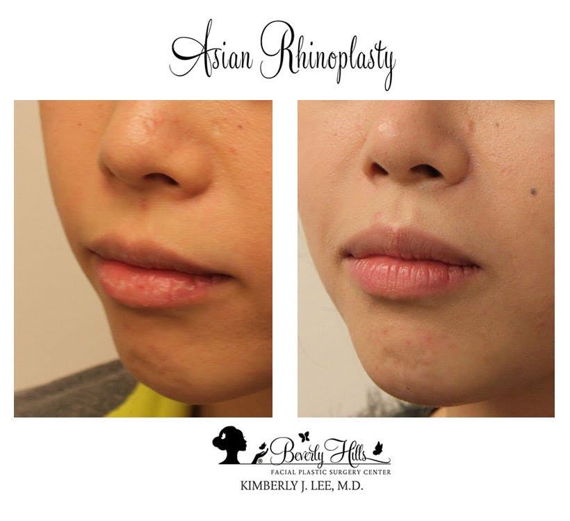 Rhinoplasty Before & After Gallery - Patient 85944606 - Image 2