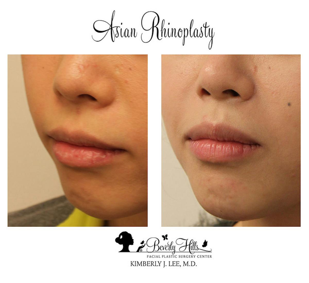 Rhinoplasty Before & After Gallery - Patient 85944606 - Image 2