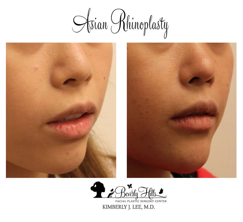 Asian Rhinoplasty in Beverly Hills & Los Angeles Before and After Photos