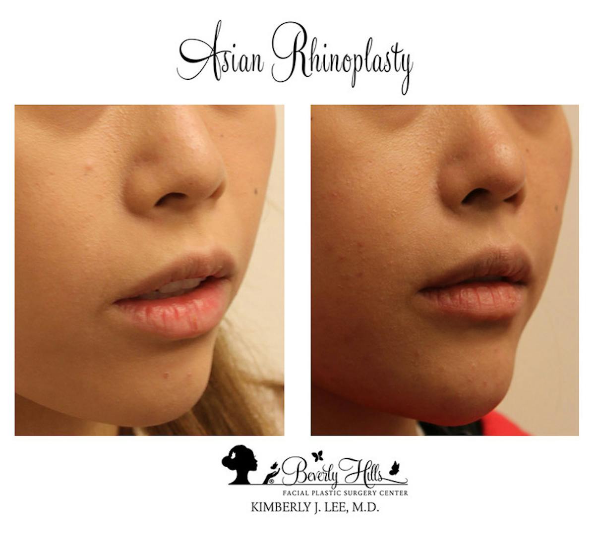 Rhinoplasty Before & After Gallery - Patient 85944606 - Image 1