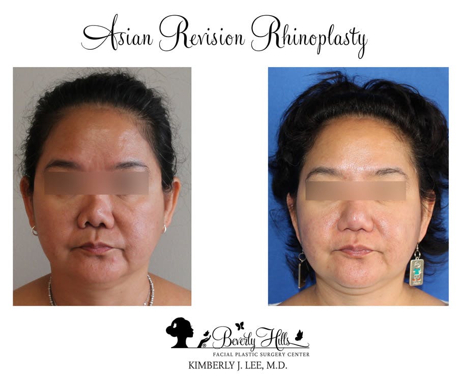 Rhinoplasty Before & After Gallery - Patient 85944611 - Image 3