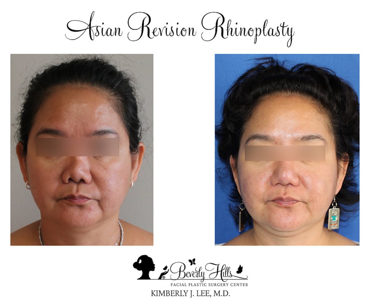 Rhinoplasty Before & After Gallery - Patient 85944611 - Image 3