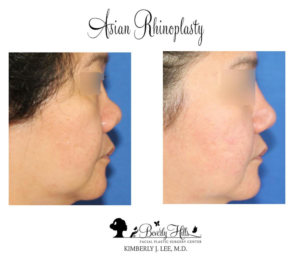 Rhinoplasty Before & After Gallery - Patient 85944611 - Image 1