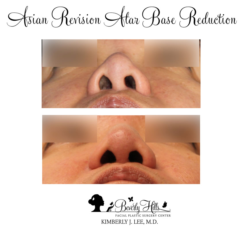 Alar Base Reduction