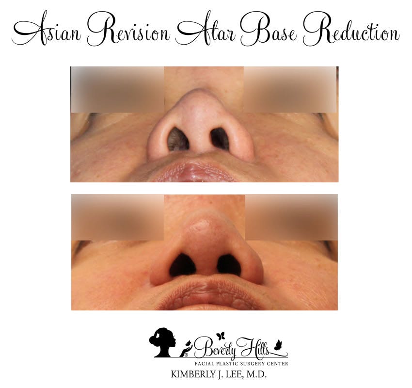 Rhinoplasty Before & After Gallery - Patient 85944614 - Image 1