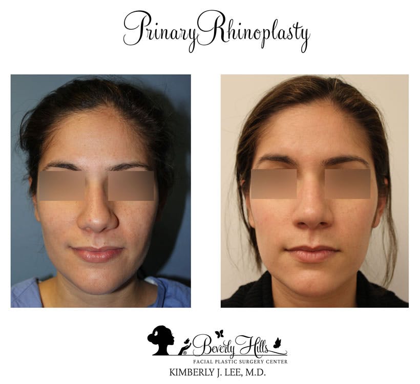 Rhinoplasty Before & After Gallery - Patient 85944615 - Image 4