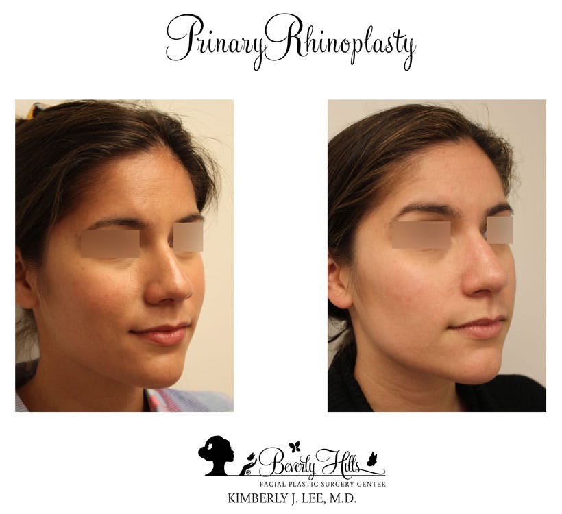 Rhinoplasty