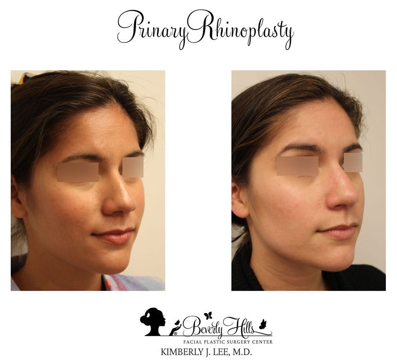 Rhinoplasty Before & After Gallery - Patient 85944615 - Image 3