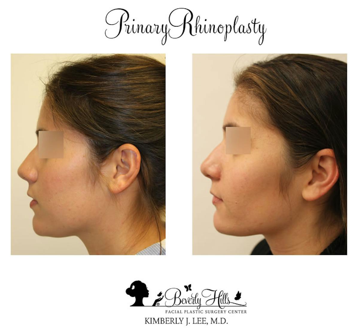 Rhinoplasty Before & After Gallery - Patient 85944615 - Image 2