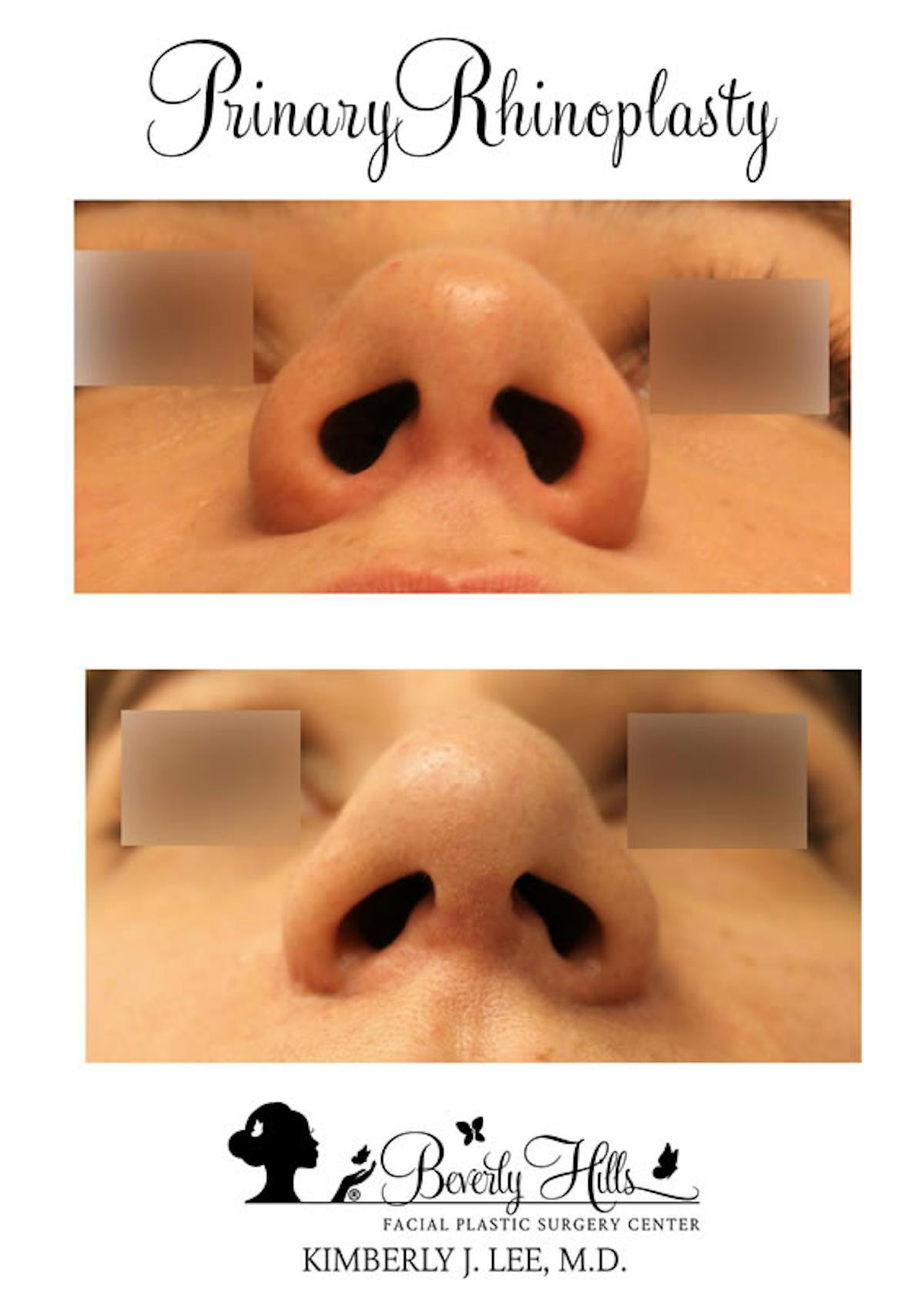 Rhinoplasty Before & After Gallery - Patient 85944615 - Image 1