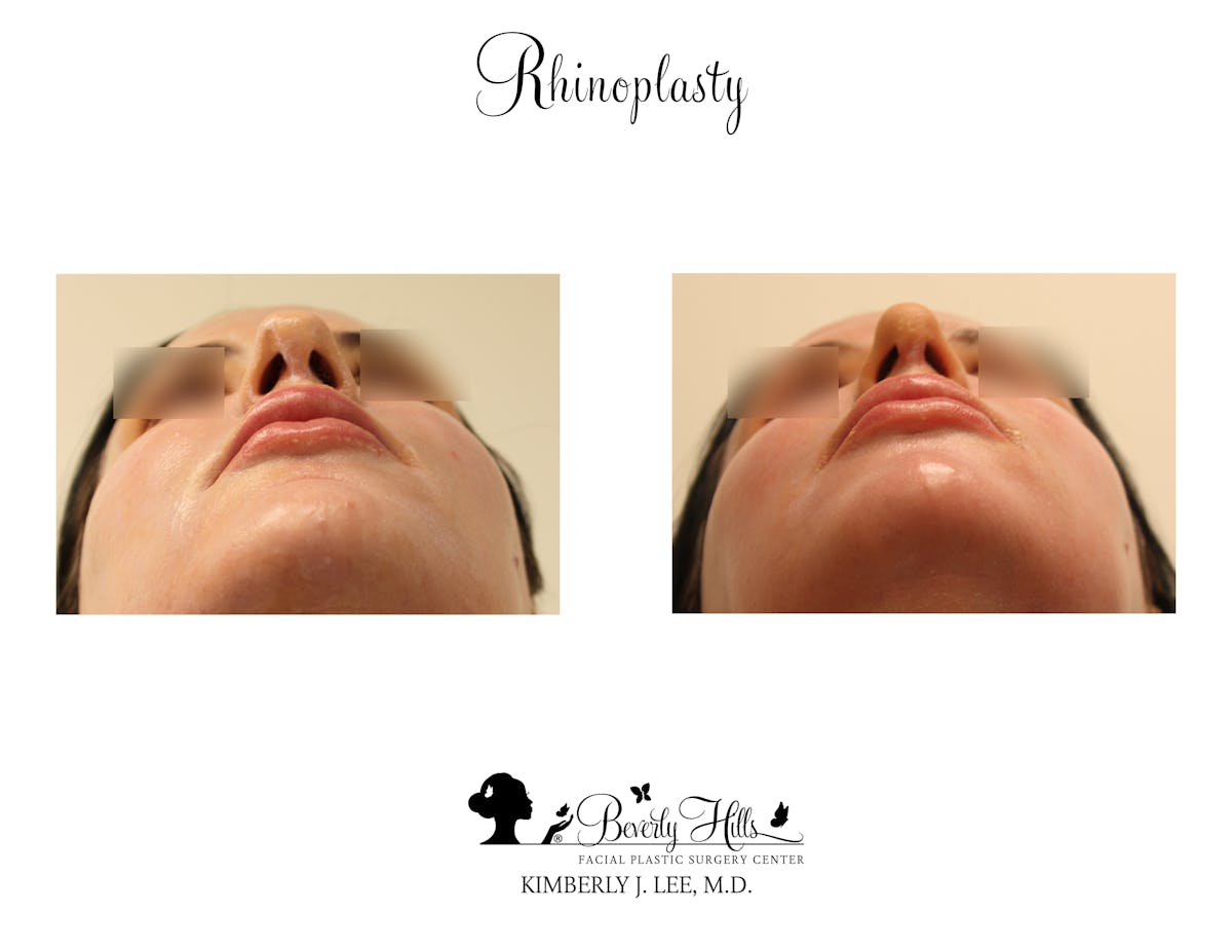 Rhinoplasty Before & After Gallery - Patient 85944620 - Image 4