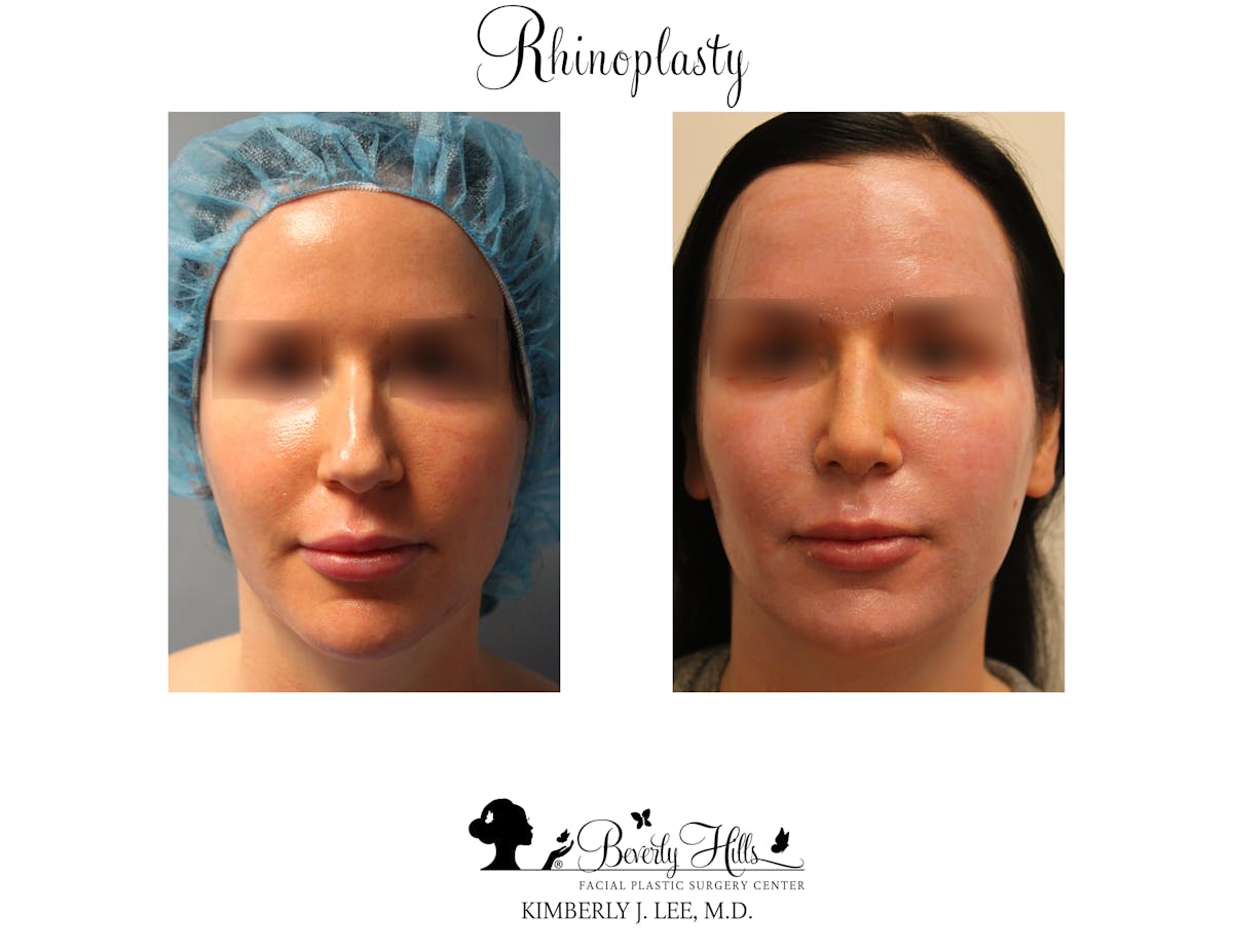 Rhinoplasty Before & After Gallery - Patient 85944620 - Image 3