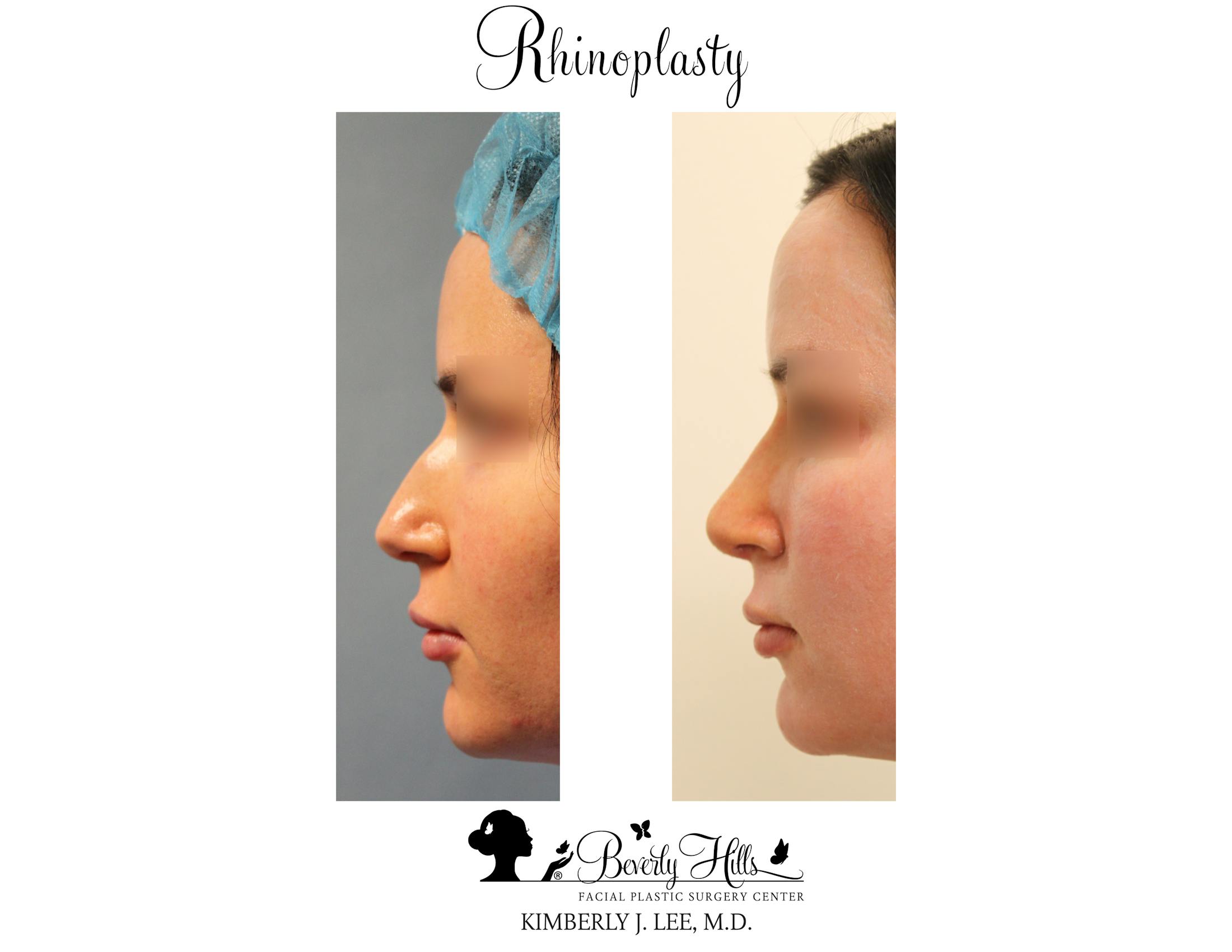 Rhinoplasty Before & After Gallery - Patient 85944620 - Image 2