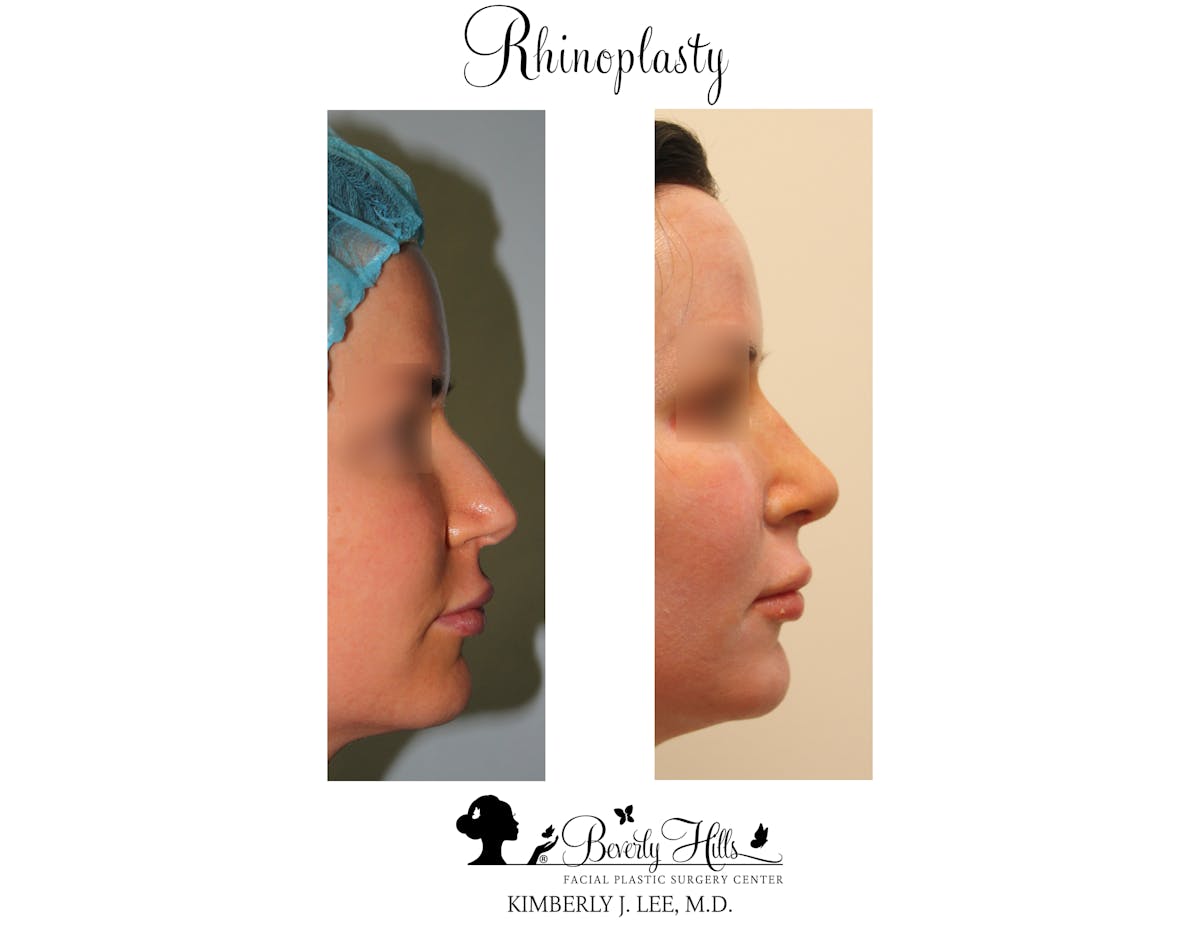Rhinoplasty Before & After Gallery - Patient 85944620 - Image 1