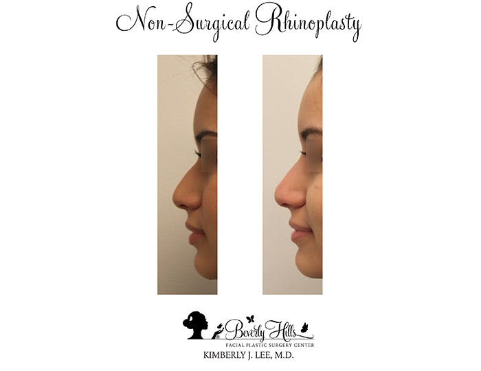 Non-Surgical Rhinoplasty Gallery - Patient 85944631 - Image 1