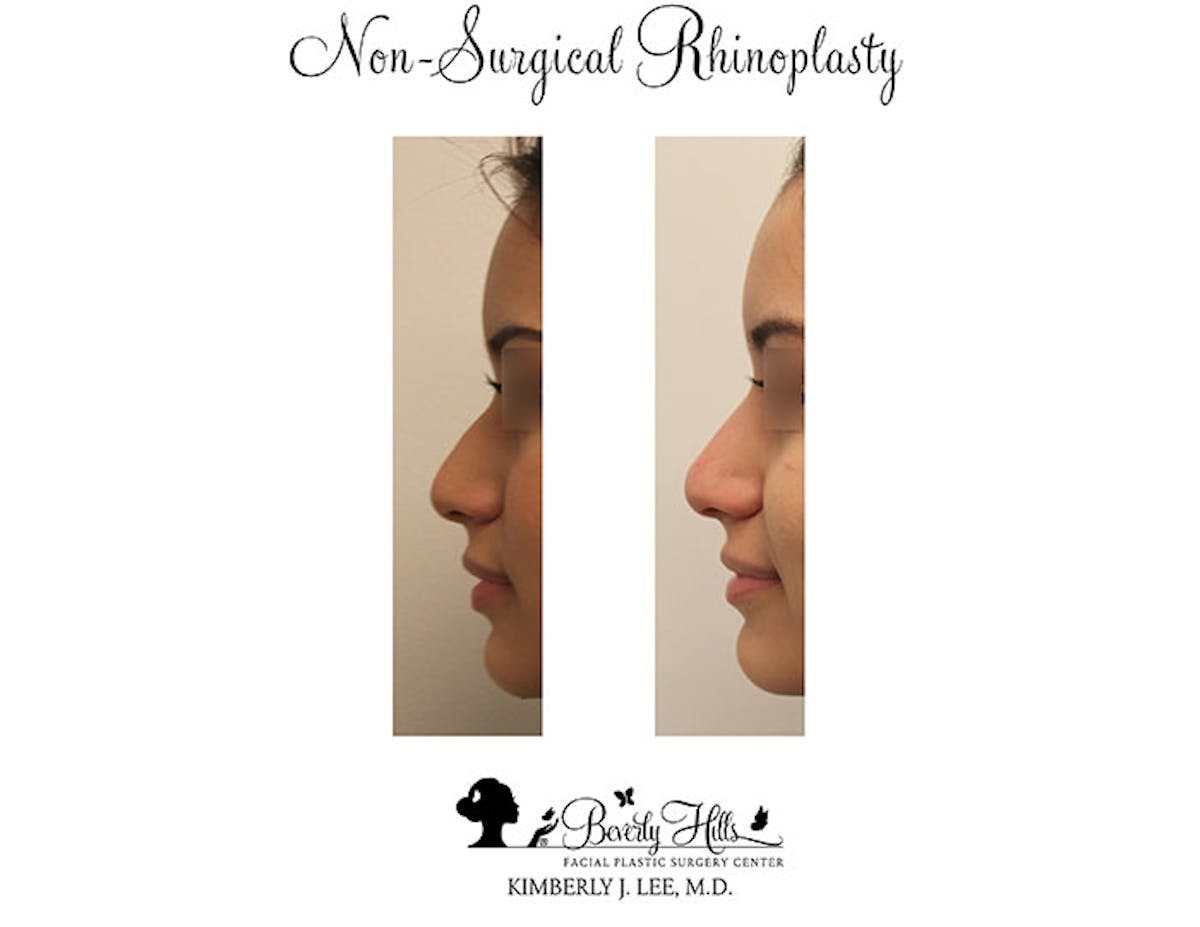 Non-Surgical Rhinoplasty Before & After Gallery - Patient 85944631 - Image 1