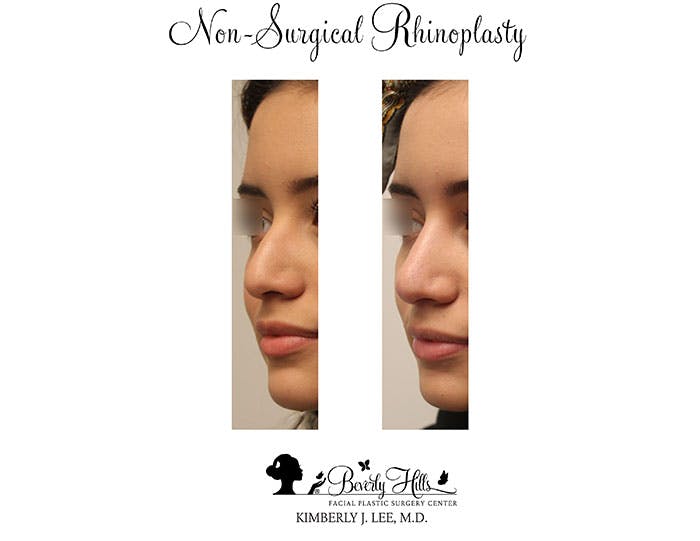 Non-Surgical Rhinoplasty