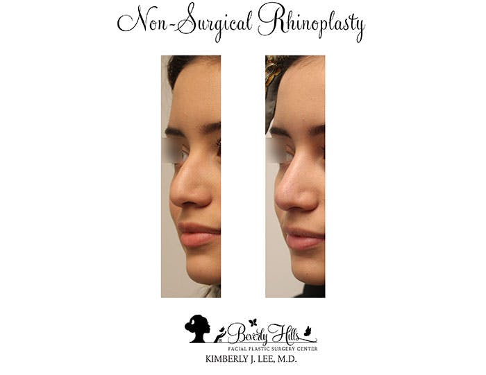 Non-Surgical Rhinoplasty Gallery - Patient 85944631 - Image 2