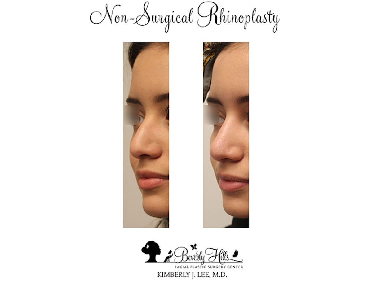Non-Surgical Rhinoplasty Before & After Gallery - Patient 85944631 - Image 2