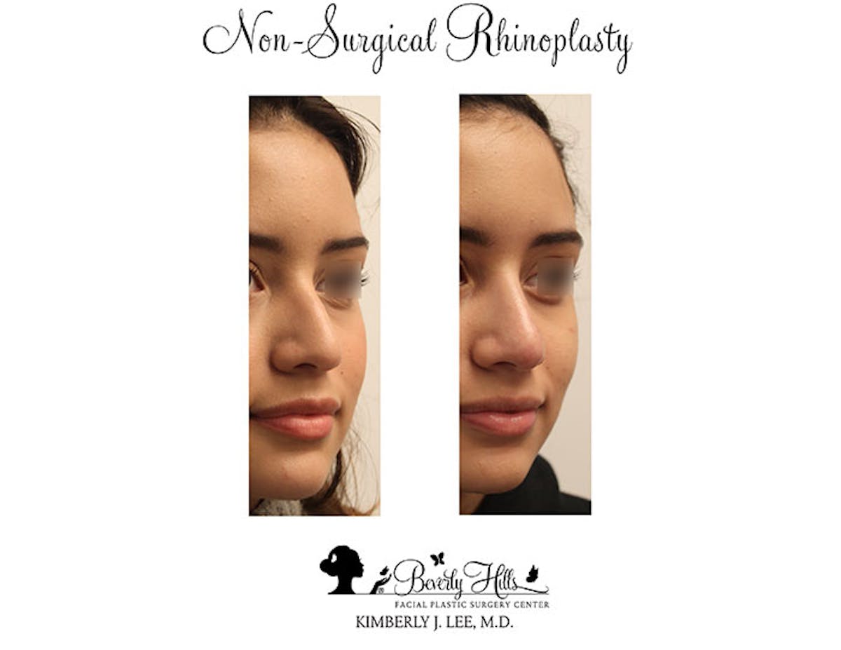 Non-Surgical Rhinoplasty Before & After Gallery - Patient 85944631 - Image 3