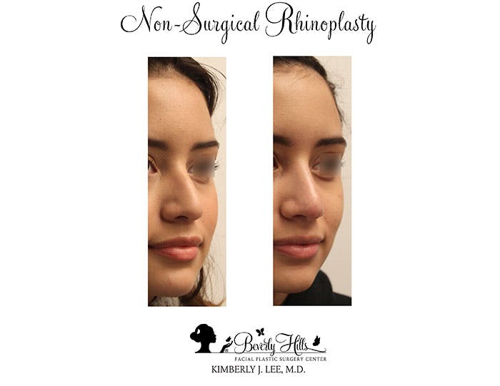 Non-Surgical Rhinoplasty Before & After Gallery - Patient 85944631 - Image 3