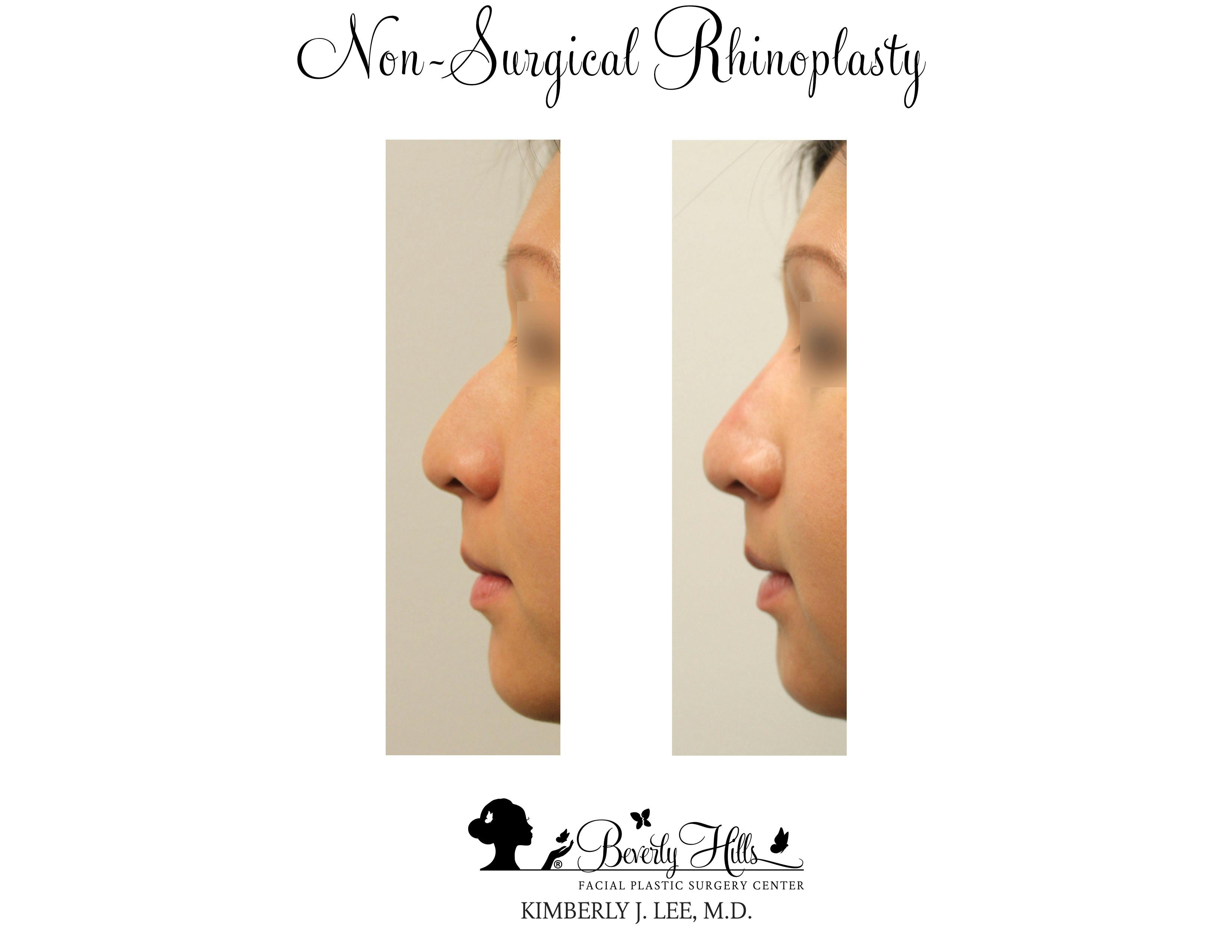 Non-Surgical Rhinoplasty Gallery - Patient 85944634 - Image 1