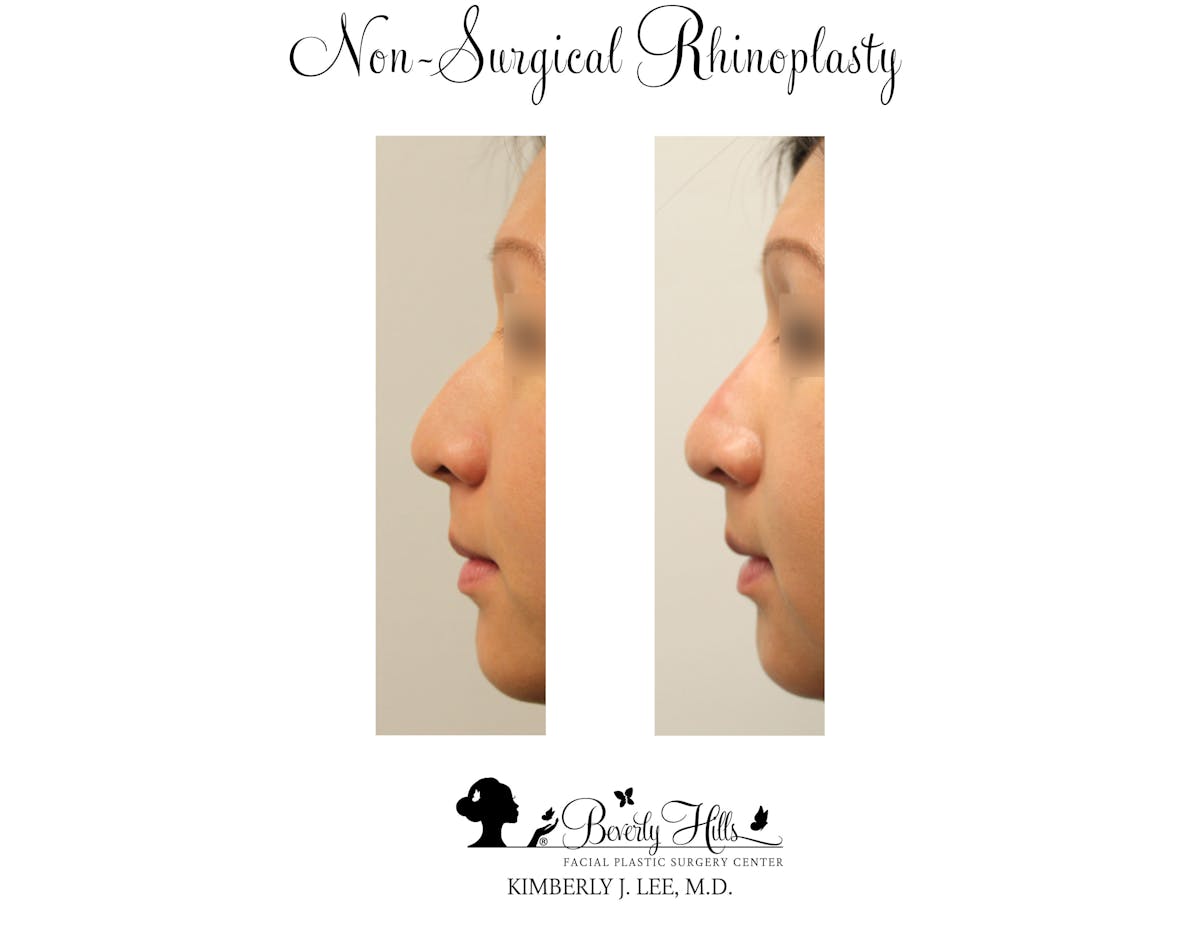 Non-Surgical Rhinoplasty Before & After Gallery - Patient 85944634 - Image 1