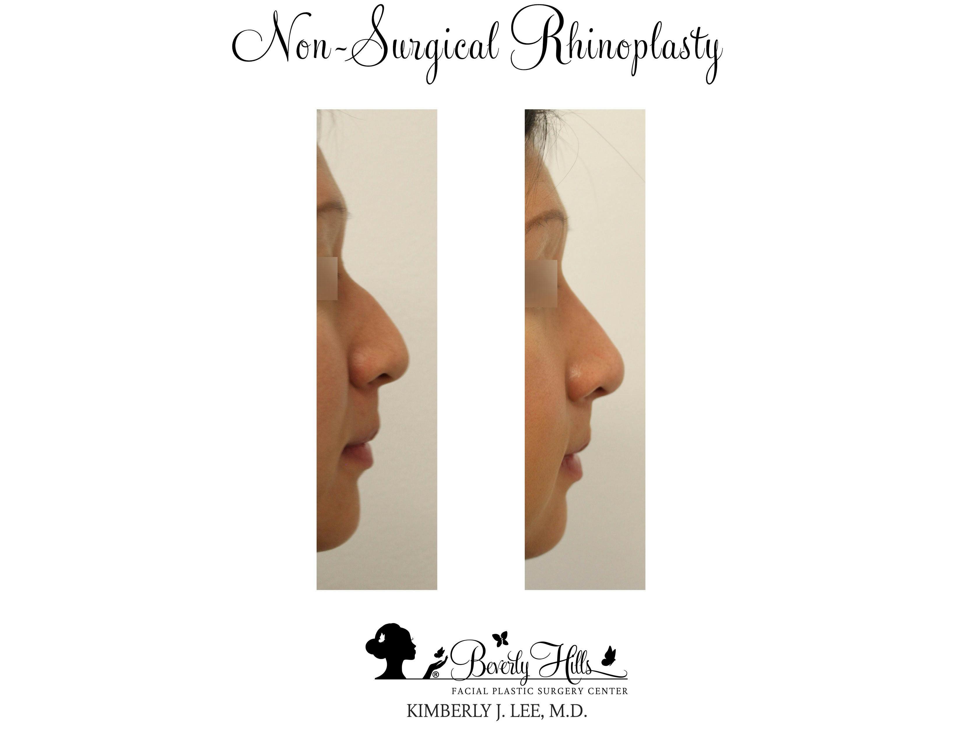 Non-Surgical Rhinoplasty Gallery - Patient 85944634 - Image 2