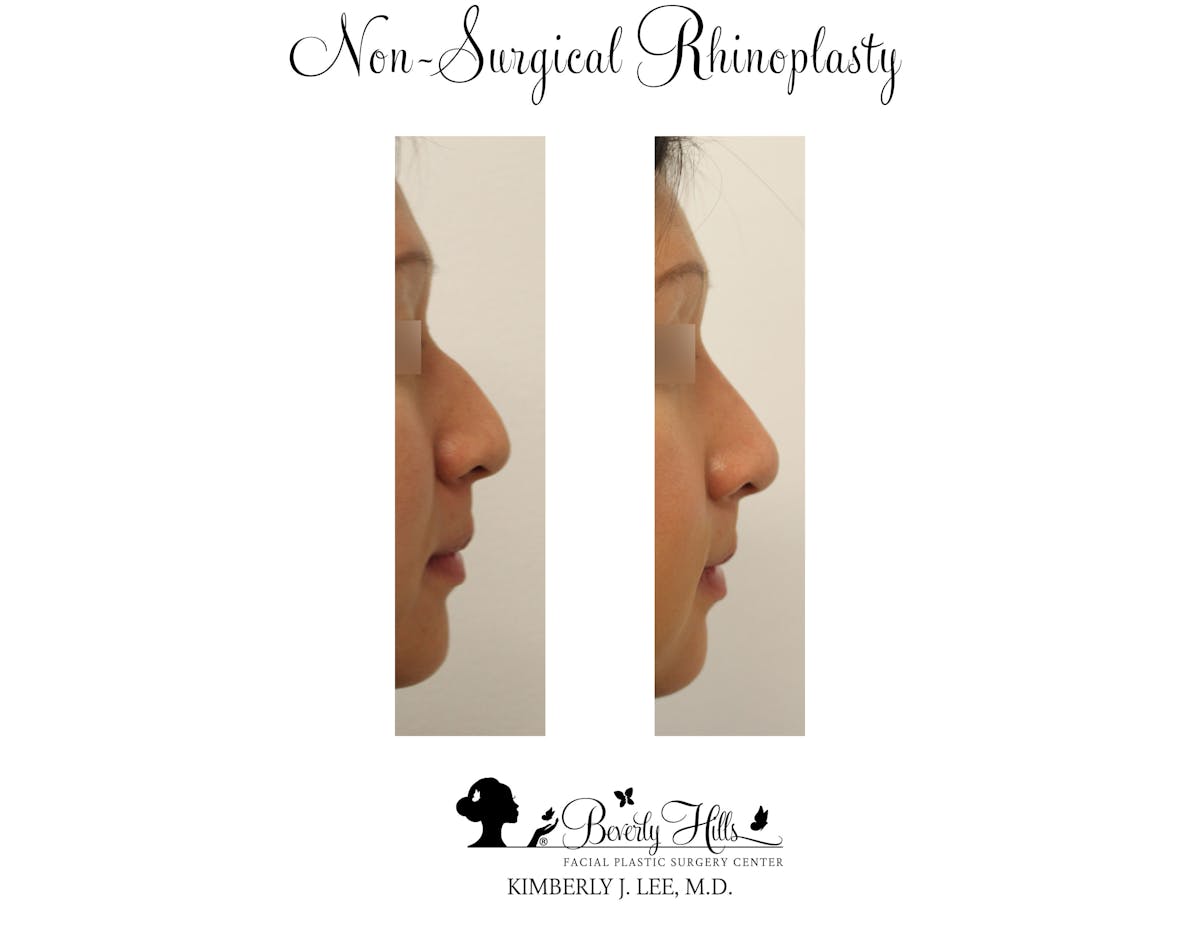 Non-Surgical Rhinoplasty Before & After Gallery - Patient 85944634 - Image 2