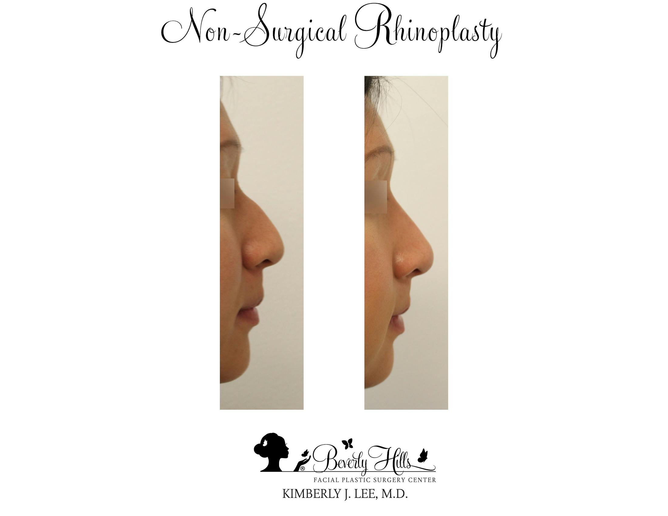 Non-Surgical Rhinoplasty Before & After Gallery - Patient 85944634 - Image 2