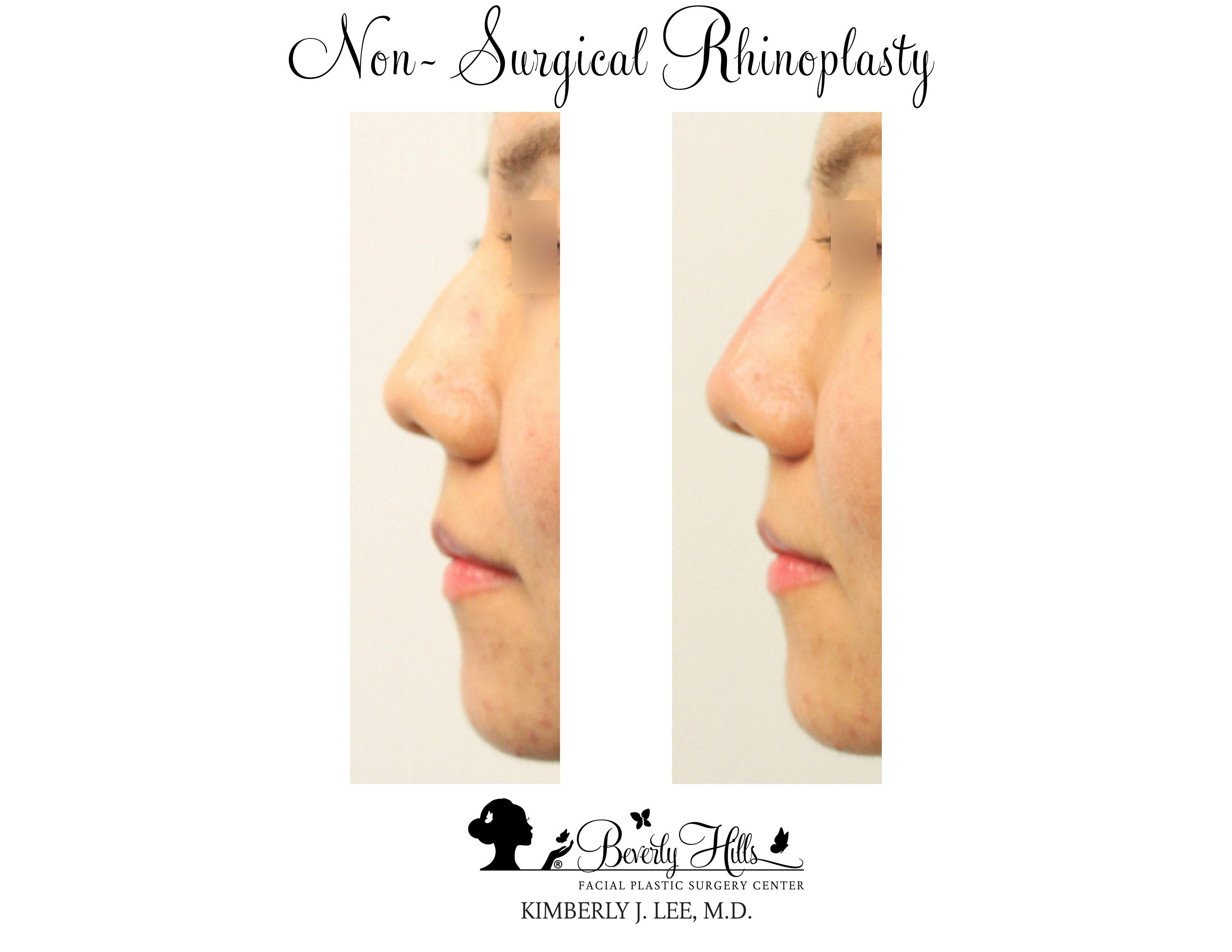 Non-Surgical Rhinoplasty Gallery - Patient 85944637 - Image 1