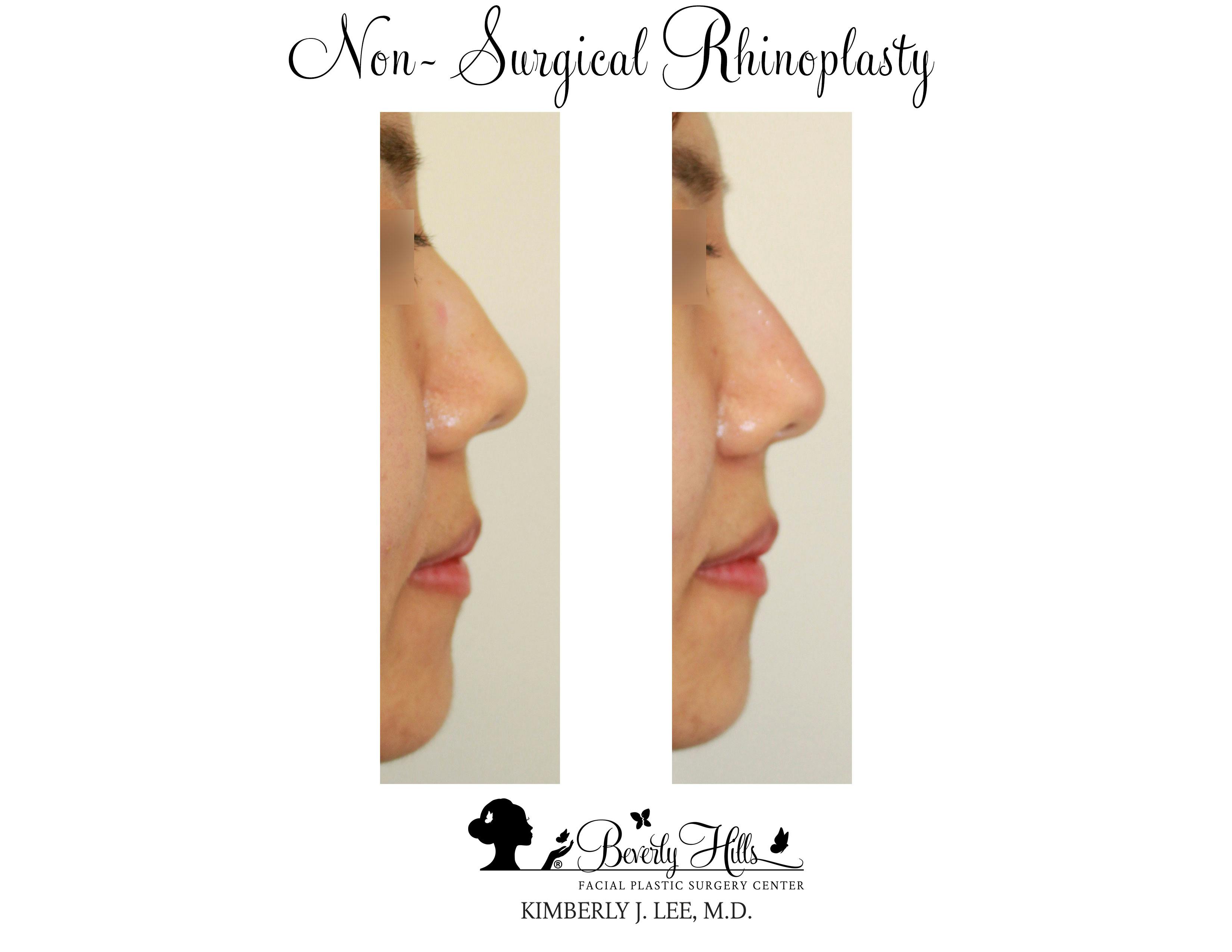 Non-Surgical Rhinoplasty Gallery - Patient 85944637 - Image 2