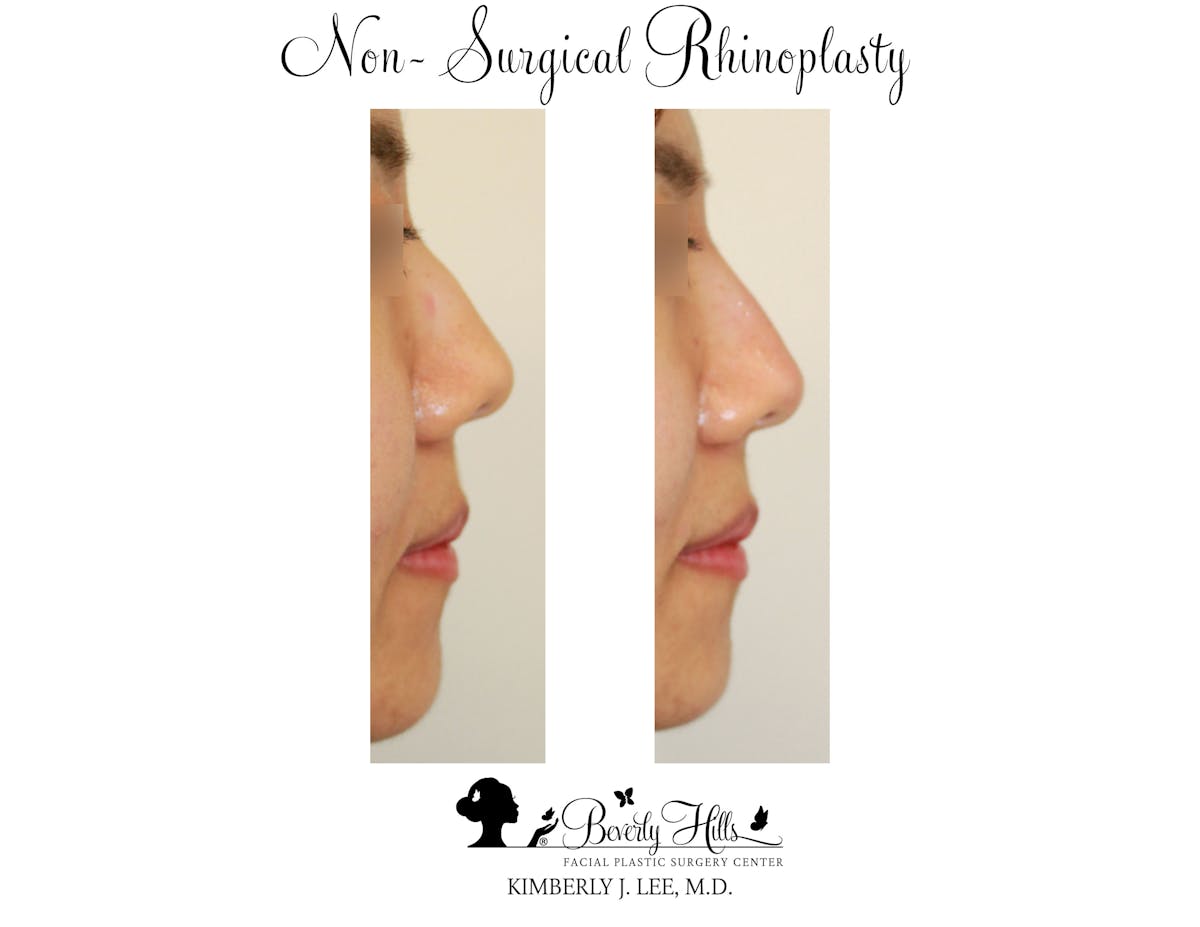 Non-Surgical Rhinoplasty Before & After Gallery - Patient 85944637 - Image 2