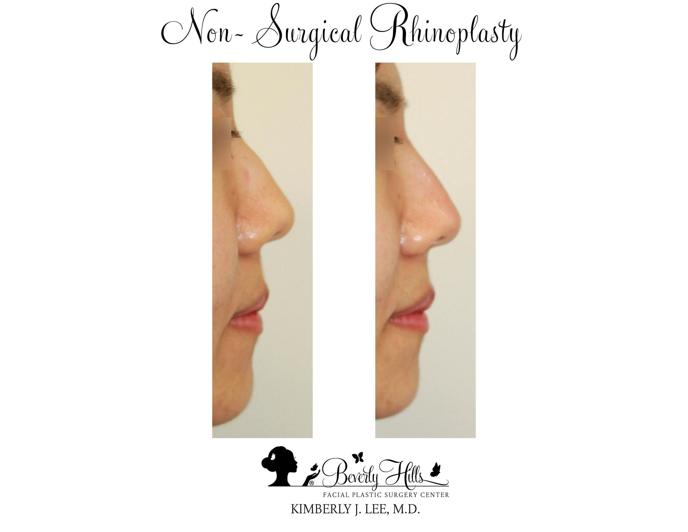 Non-Surgical Rhinoplasty Before & After Gallery - Patient 85944637 - Image 2