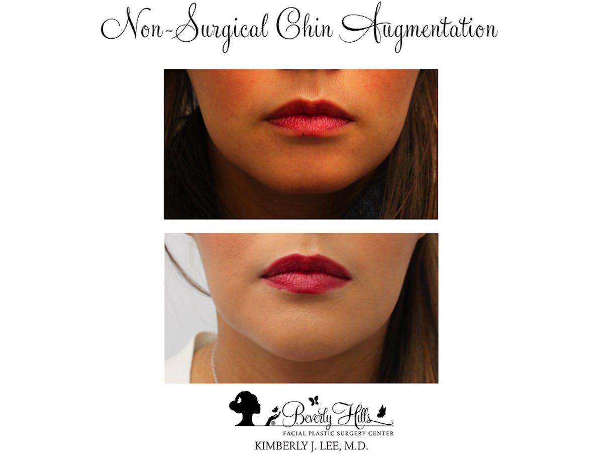 Non-Surgical Chin Augmentation Before & After Gallery - Patient 85944643 - Image 1