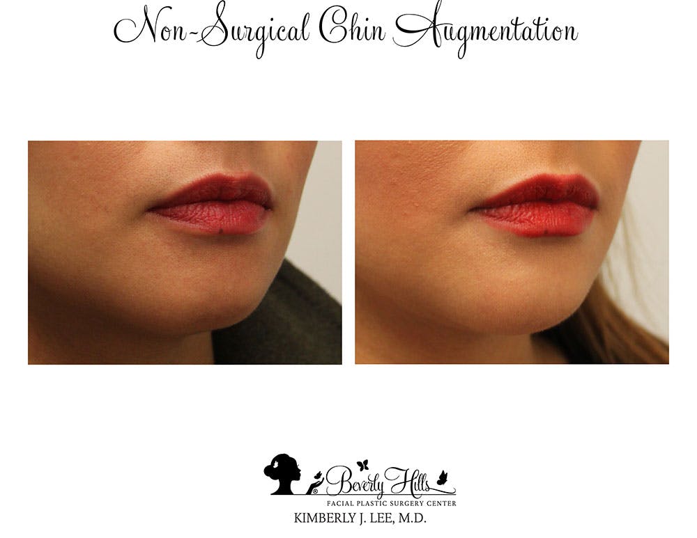 Non-Surgical Chin Augmentation Gallery - Patient 85944643 - Image 2