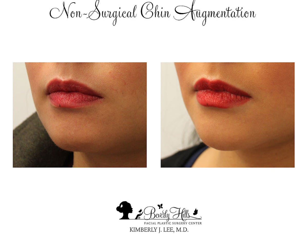 Non-Surgical Chin Augmentation Before & After Gallery - Patient 85944643 - Image 3