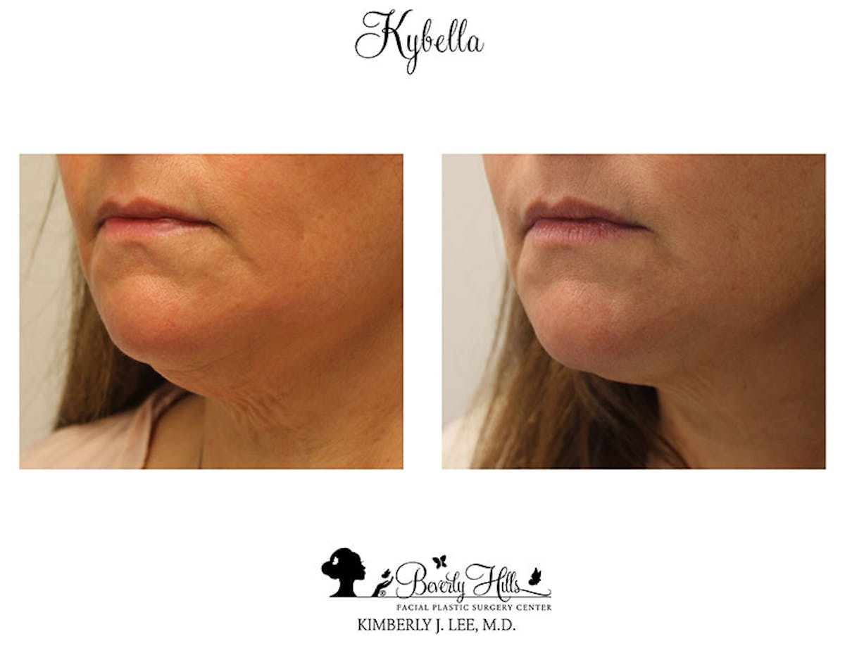 Kybella Before & After Gallery - Patient 85944751 - Image 3