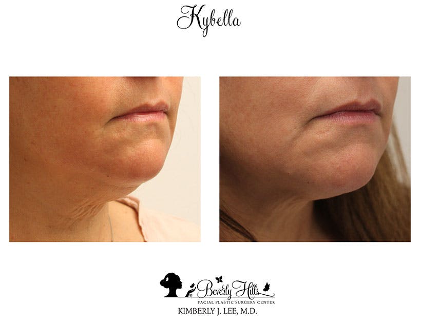 Kybella Before & After Gallery - Patient 85944751 - Image 4
